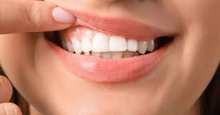 Patient after smile design and veneers