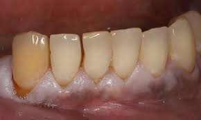 Patient before smile design treatment